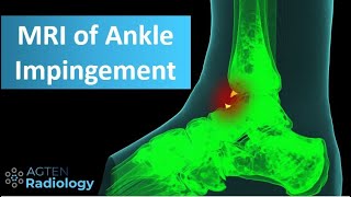 MRI of Anterior Ankle Impingement [upl. by Iba]