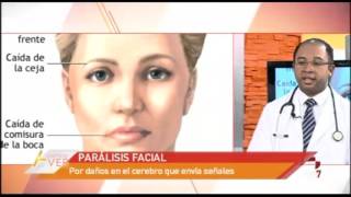 Vamos a ver Diferencia entre parálisis facial e ictus [upl. by Aldon]