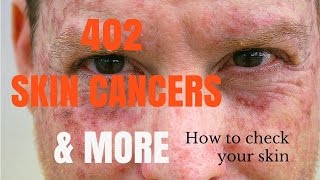 How to spot skin cancers [upl. by Neeroc]