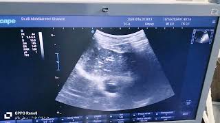 nephropathy accidentally diagnosed by ultrasound ازاي نشخص قصور الكلى بالسونار [upl. by Nelo]