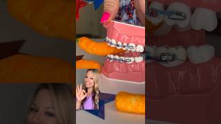 CHIPS YOU CANT EAT WITH BRACES ON 🦷 Orthodontist Reacts w BETTER OPTIONS CRUNCHY FOOD ASMR [upl. by Abigale336]