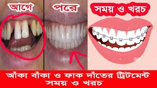 আঁকা বাঁকা দাঁত সোজা করা  aka baka dat soja korar upay ।।orthodontic treatment ।। uchu dat nichu [upl. by Vareck75]