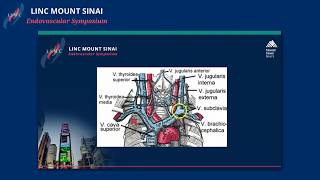 Managing Central Venous Stenosis in Dialysis Patients [upl. by Sarad]