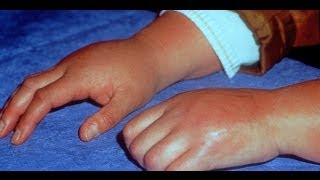 Learn About Reflex Sympathetic Dystrophy  Also Known as Reflex Pain [upl. by Richter315]