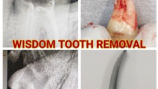 HOW TO REMOVE WISDOM TOOTH AND RCT TREATED TOOTH USING COUPLAND ELEVATOR [upl. by Adolfo892]