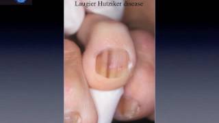 Nail pigmentation beginners level by Dr Luc Thomas [upl. by Akirat]