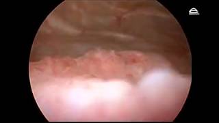 Cystitis cystica Cystoscopy findings [upl. by Schuyler]