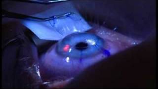 Laser Eye Surgery  The Patient Experience at London Vision Clinic on Harley St London [upl. by Rdnaskela]