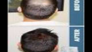 Provillus Hair Loss Before and After Pics [upl. by Utta828]