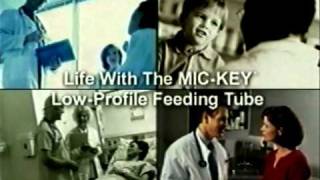 Life with MICKEY LowProfile Gastrostomy Feeding Tube  An Educational Overview  English [upl. by Adnaluy932]