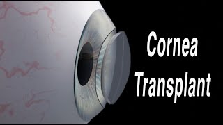 Cornea Transplant Penetrating Keratoplasty [upl. by Griffin207]