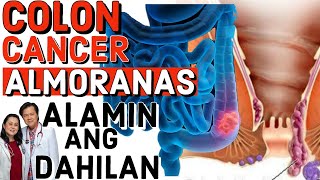 Colon Cancer Almoranas Alamin ang Dahilan Paano Maiiwasan  Payo ni Doc Willie Ong 295d [upl. by Chamkis]