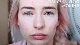 Roaccutane Daily Skin Vlog  Month 3 [upl. by Larue]