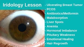 Iridology Reading  Detoxing Breast Cancer [upl. by Crescantia]