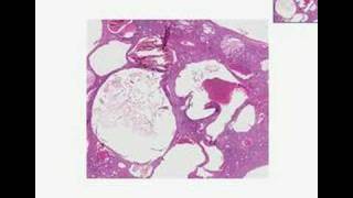 Histopathology KidneyAdult polycystic disease [upl. by Lonergan]