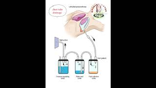 Chest tube drainage nursingnotes360° pneumothorax music nursing [upl. by Jabez]