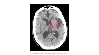 Cerebrovascular Disease for the USMLE Step 1 [upl. by Phelips]