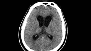 Hydrocephalus after SAH CT [upl. by Hendrickson]