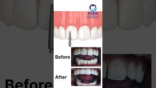 Before amp After Filling Gaps Between Teeth  Shahi Dental Clinic Muzaffarpur [upl. by Vange]