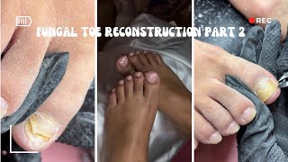 DEEP CLEANING OF FUNGUS TOESACRYLIC TOES TOE BBL [upl. by Lunneta]