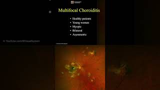 Multifocal Choroiditis ophthalmology optometry [upl. by Latini621]