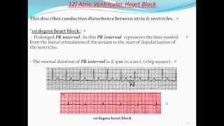 Principles of ECG quotelectrocardiographyquot Part 11 [upl. by Cyb132]