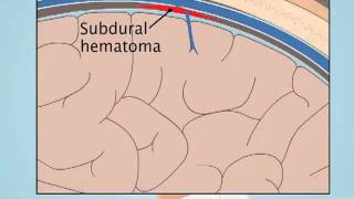 Understanding Subdural Hematoma [upl. by Hars935]