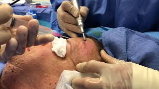 Surgeon Explains Dermabrasion for Cutaneous Neurofibromas [upl. by Pathe]