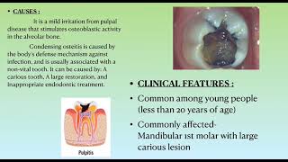 condensing osteitis [upl. by Estes]