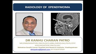 EPENDYMOMA RADIOLOGY [upl. by Tillford]