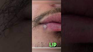 Behind these common skin lesions clinical Skin [upl. by Woodford53]