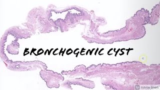 Bronchogenic Cyst 5Minute Pathology Pearls [upl. by Anehs]