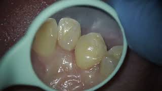 treatment of caries and composite filling on the tooth dentist teeth dental cavity dentistry [upl. by Lertsek]