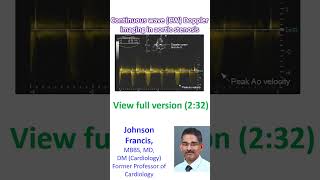 Continuous wave CW Doppler imaging in aortic stenosis [upl. by Ardnaxila]