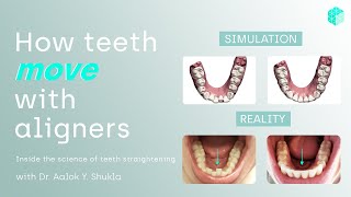 How teeth move with aligners  now explained [upl. by Ultann375]