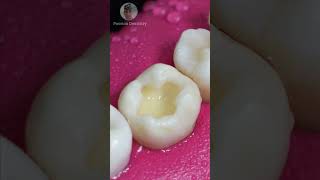 Repairing Dental Caries toothrestoration shorts [upl. by Allenrad]