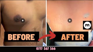 Do you want to see gynecomastia surgery results from 1 centre for gynecomastia treatments [upl. by Kutzenco959]