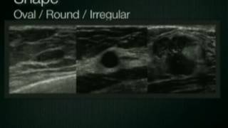 Breast Ultrasound Lesion Assessment BIRADS Ultrasound [upl. by Anaud]