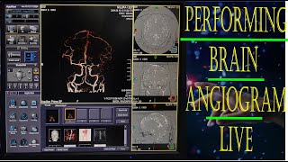 CT Scan of Brain Angiogram ll Live Scanning amp Processing Technique basicradiology ctscan [upl. by Nnalyrehs]