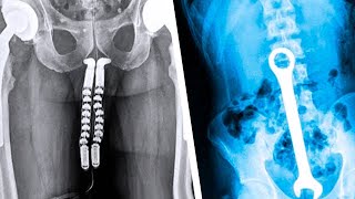 20 Strangest Things Discovered by XRays [upl. by Vachil]