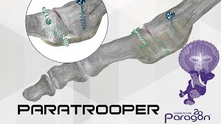 PARATROOPER Plantar Plate Repair System by Paragon28 [upl. by Enitsua754]