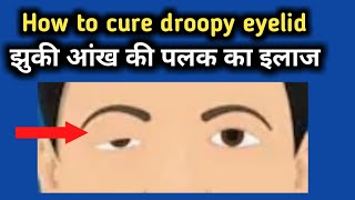 How to cure droopy eyelid  droopy eyelid exercise  jhuki aankh ki palak kaise theek kare  eyelid [upl. by Aetnuahs684]