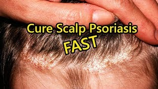 Scalp Psoriasis Home Remedies  How to Cure Scalp Psoriasis FAST [upl. by Aneerak912]