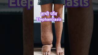 हाथी पांव Elephantiasis ये कौन सी बीमारी है filaria [upl. by Akinas]