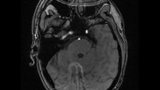 MRT nach Schlaganfall  MRI after ischemic stroke 2 [upl. by Anoi]