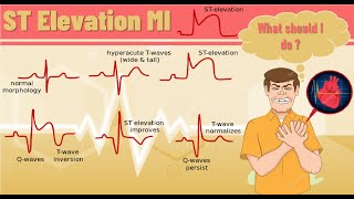 ST elevation myocardial infarction STEMI  ST elevation MI pathophysiology ECG finding and example [upl. by Hildagard512]