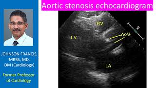 Aortic stenosis  echocardiogram [upl. by Selrhc598]