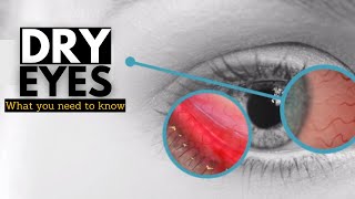 Dry Eye Syndrome Causes Signs and Symptoms Diagnosis and Treatment [upl. by Soisinoid]