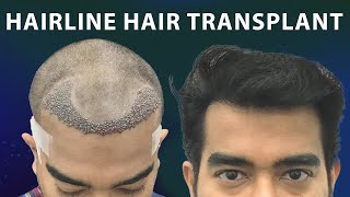 Natural Looking Hairline Transplant at Hairfree Hairgrow Clinic Kolkata using Sapphire FUE Method [upl. by Eckblad]