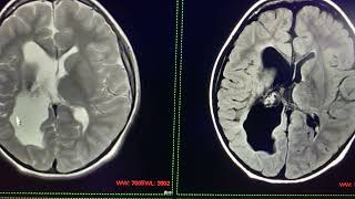 Retraso psicomotriz relacionado con Malformación cerebral secundaria a infarto hemorragico [upl. by Ellenohs704]